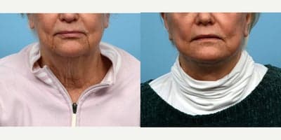 Case 9792 - 65-74 year old woman treated with Facelift, Lower Facelift, Neck Lift, SMAS Facelift, CO2 Laser, Laser Resurfacing