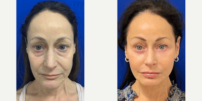 Case 9793 - 56 year old woman treated with Laser Resurfacing