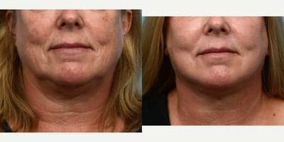 Case 9794 - 65-74 year old woman treated with Laser Resurfacing
