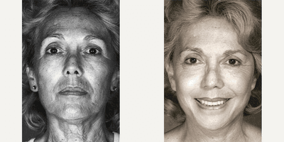 Case 9796 - Woman treated with Laser Resurfacing