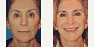 Case 9797 - Woman treated with Laser Resurfacing