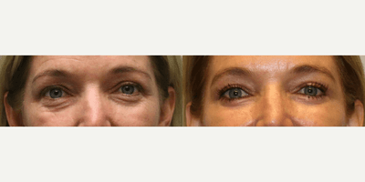 Case 9802 - Woman treated with Laser Resurfacing