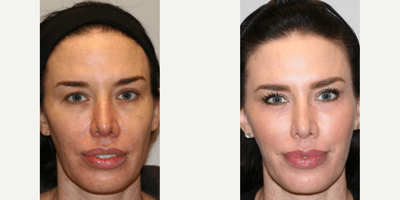 Case 9803 - Woman treated with Laser Resurfacing