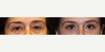 Case 9807 - Woman treated with Laser Resurfacing