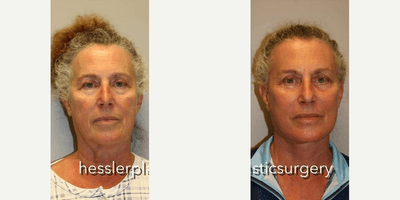 Case 9835 - Woman treated with Laser Resurfacing