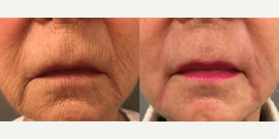 Case 9837 - Woman treated with Laser Resurfacing