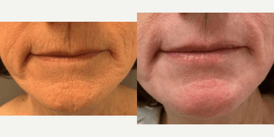 Case 9845 - 65-74 year old woman treated with Laser Resurfacing