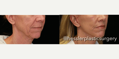 Case 9864 - Woman treated with Laser Resurfacing
