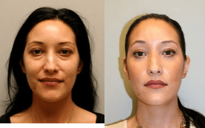 Case 9865 - Woman treated with Laser Resurfacing
