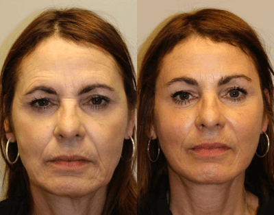 Case 9885 - Woman treated with Laser Treatment