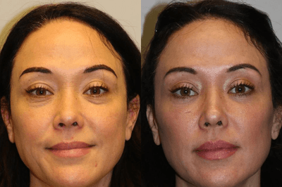 Case 9886 - Woman treated with Laser Treatment