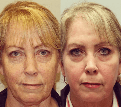 Case 9887 - Woman treated with Laser Resurfacing