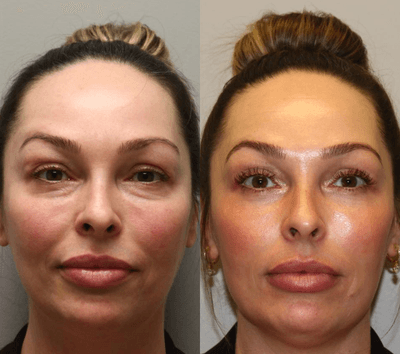 Case 9888 - Woman treated with Laser Treatment
