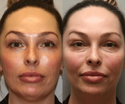 Case 9891 - Laser Resurfacing