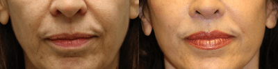 Case 9892 - Laser Treatment