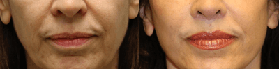 Case 9893 - Laser Resurfacing