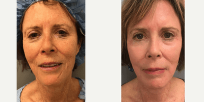Case 9894 - 65-74 year old woman treated with Laser Resurfacing