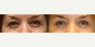 Case 9897 - Woman treated with Laser Resurfacing
