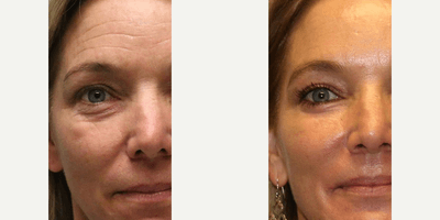 Case 9899 - Woman treated with Laser Resurfacing