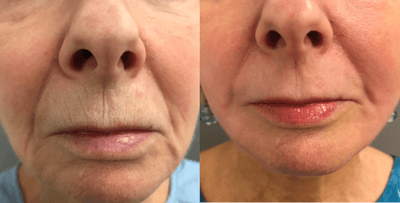 Case 9904 - 55-64 year old woman treated with Laser Resurfacing