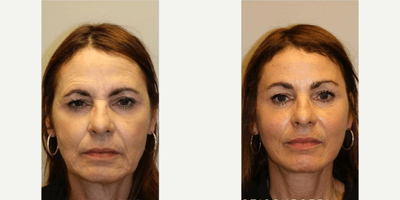 Case 9905 - Woman treated with Laser Resurfacing