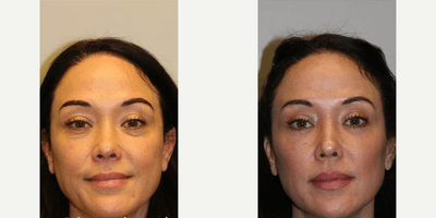 Case 9906 - Woman treated with Laser Resurfacing