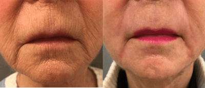 Case 9908 - 65-74 year old woman treated with Laser Surgery