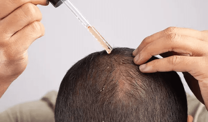 Non Surgical Hair Loss Medication