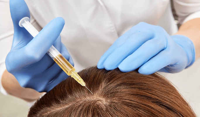 PRP Hair Treatment