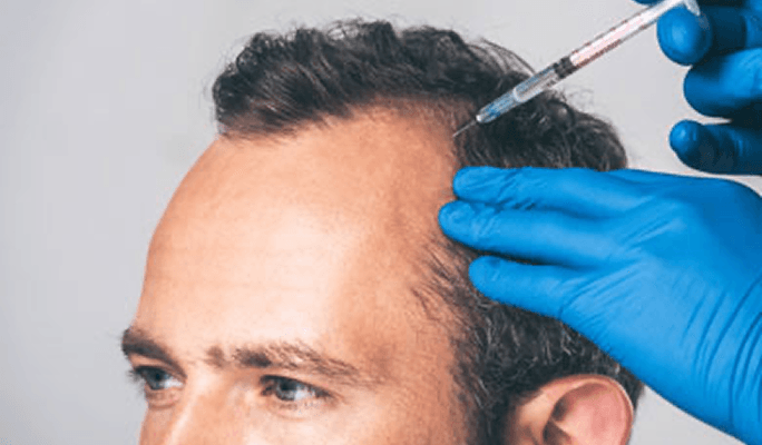Stem Cell Treatment for Hair Loss
