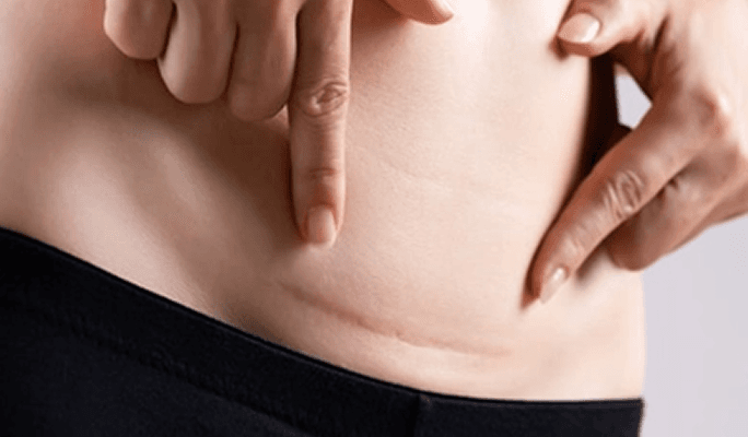 Stem Cell Therapy for Scars