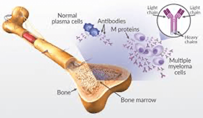 Multiple Myeloma (MM)