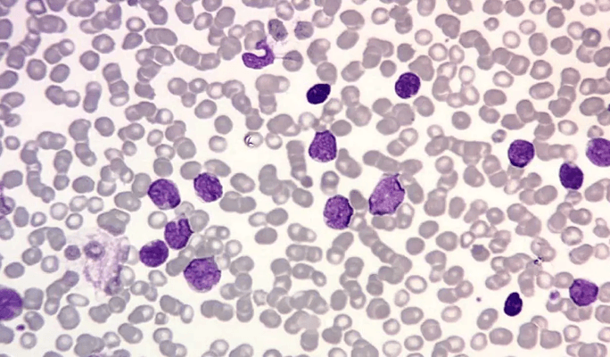 T-ALL (Acute Lymphoblastic Leukemia)