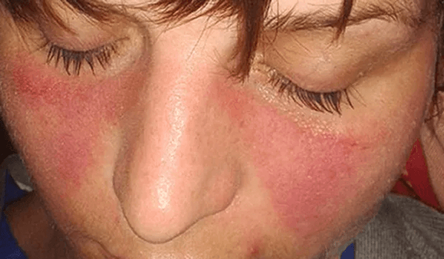 Fatigue and tiredness after the procedure