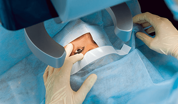 Ahmed Glaucoma Valve Implantation Operation