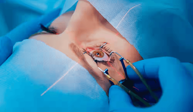 Dry eyes after the procedure