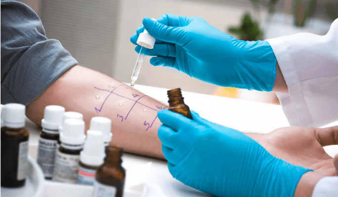 Hypersensitivity Testing