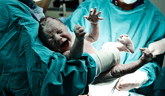 Delivery or Child Birth