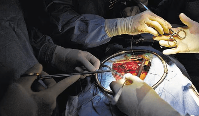 Heart Valve Replacement Surgery