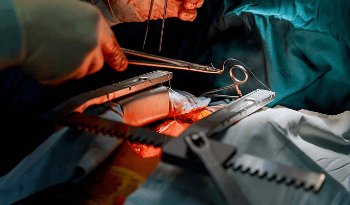 Heart Bypass Surgery