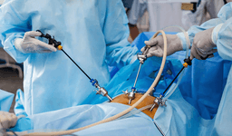 Laparoscopic Cholecystectomy