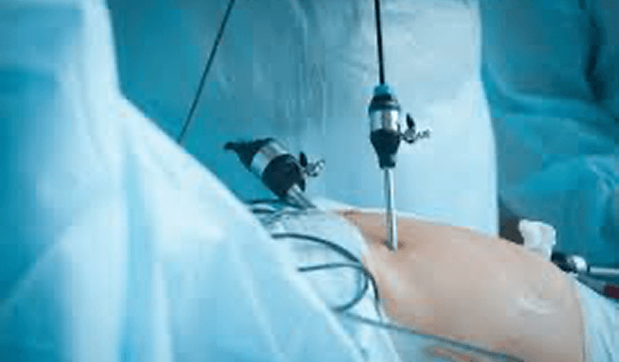 Anti Reflux Surgery Procedures
