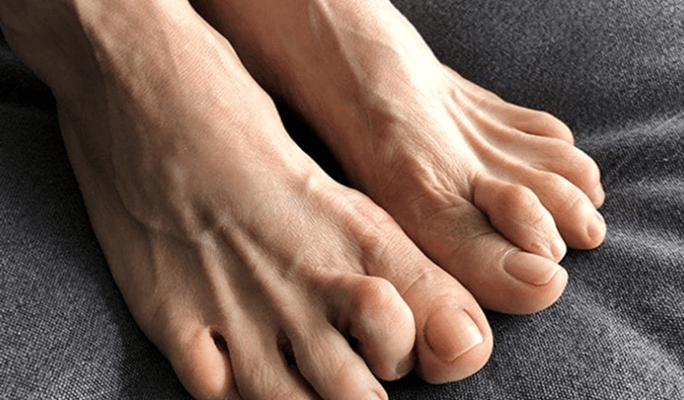 Hammer Toes Treatment