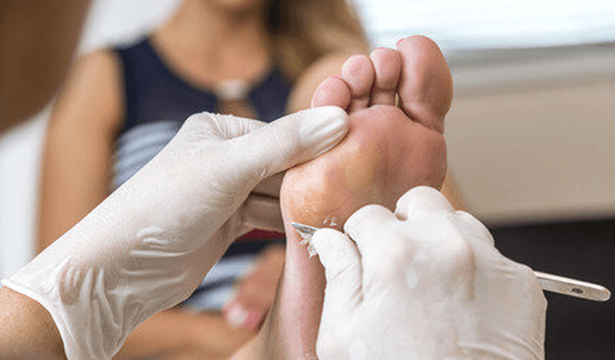 Calluses Treatment without Pain