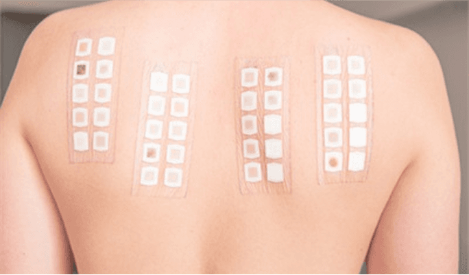 Allergy Testing