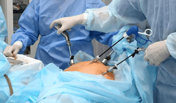 Gallbladder Removal Surgery