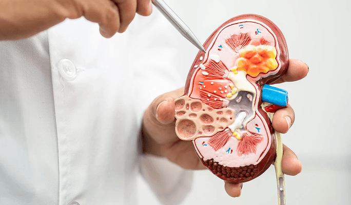 Kidney Stone Removal