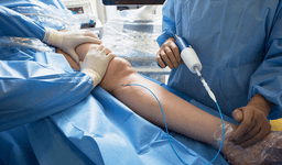 Varicose Vein Treatment