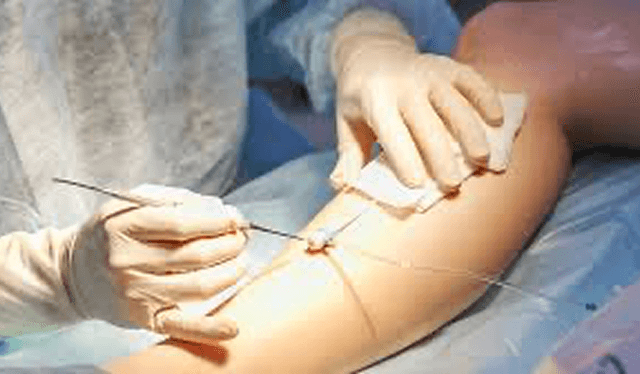 Numbness or tingling at the procedure site