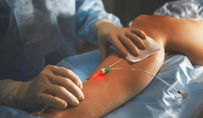 Vascular Angioplasty